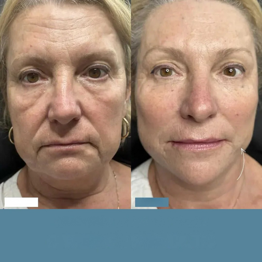 SINTIVO™ Zacht Anti-Aging Gereedschap