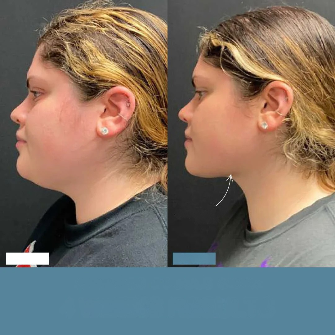 SINTIVO™ Zacht Anti-Aging Gereedschap