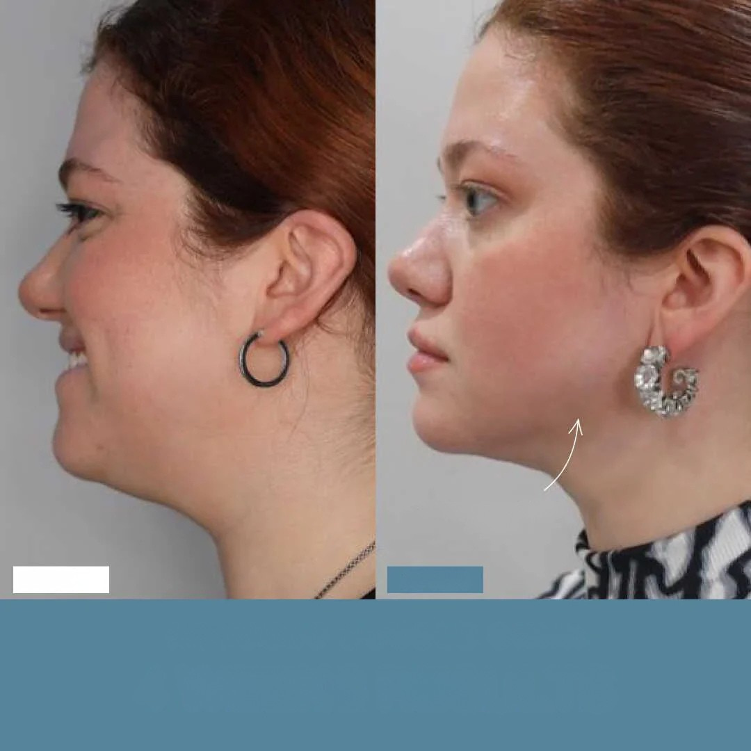 SINTIVO™ Zacht Anti-Aging Gereedschap
